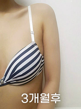 순수지방추출 룩팻 전후사진
