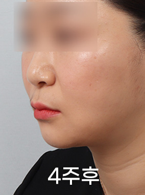4X미니리프팅 전후사진