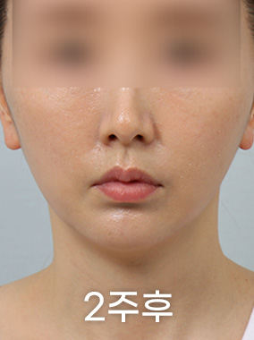 4X미니리프팅 전후사진