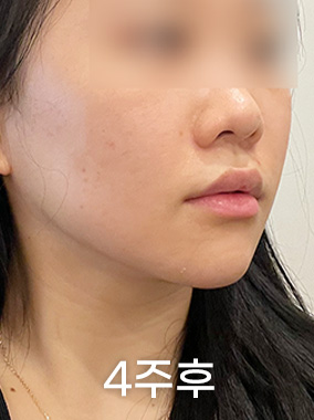 4X미니리프팅 전후사진