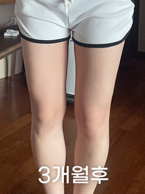 허벅지 지방흡입 전후사진