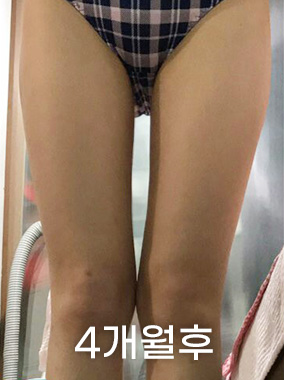 허벅지 지방흡입 전후사진