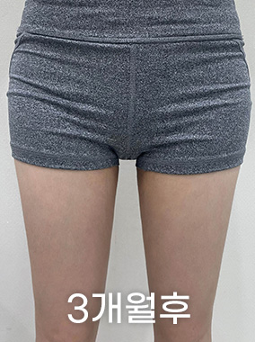허벅지 지방흡입 전후사진