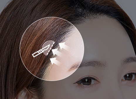 STEP 02 스마스층 일부를 당겨 고정 늘어진 피부 제거