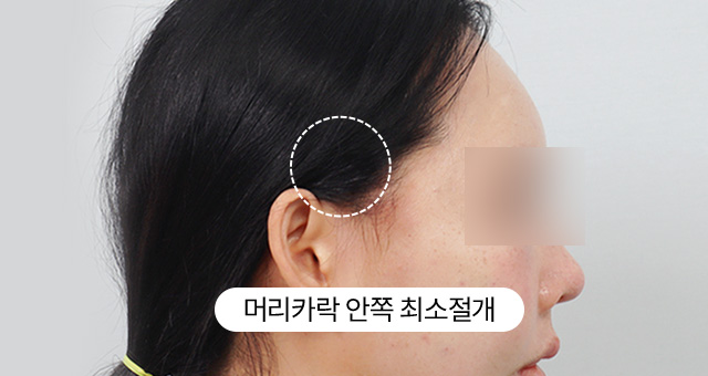 흉터 걱정 전격 실험 팔자 미니리프팅 24시간 후 생생  촬영