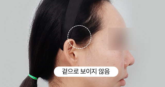 흉터 걱정 전격 실험 팔자 미니리프팅 10일 후 생생 촬영