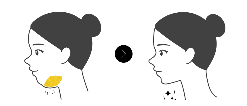 턱에 지방이 많은 경우 턱 부위 피부탄력이 떨어진 경우 반영구적인 효과를 원하는 경우 이중턱이 고민인 경우