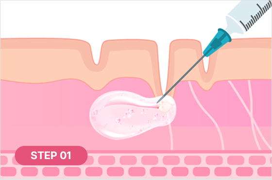 PLA성분 분해되며 자가 콜라겐 생성 촉진 STEP 01