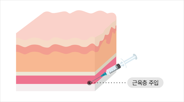 일반보톡스