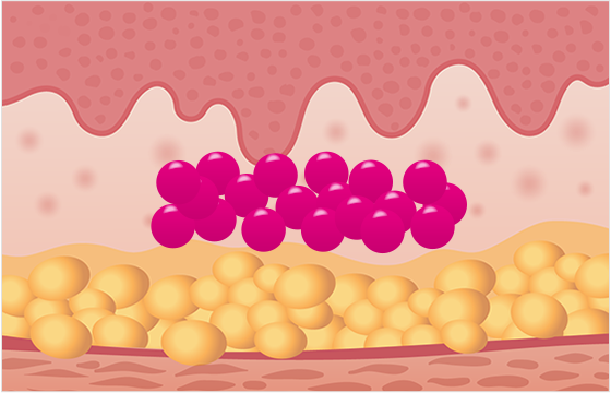 PDO粒子が分解され、コラーゲン再生成によってさまざまな効果が現れる