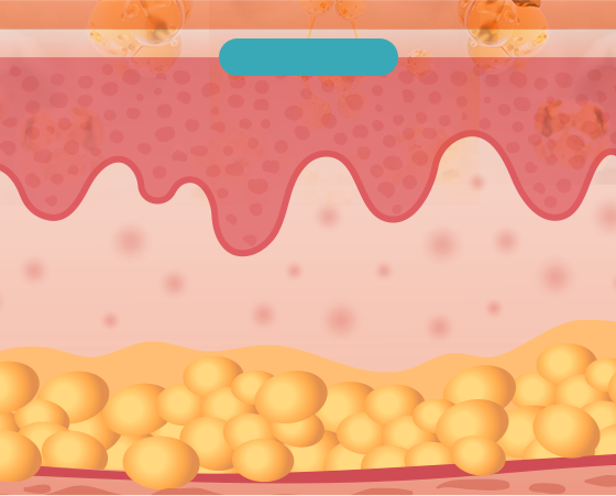 즉각적인 볼륨 형성, 저분자 HA로 분해