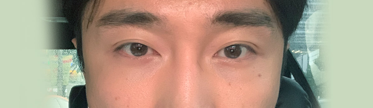 눈밑지방 재배치 전후사진