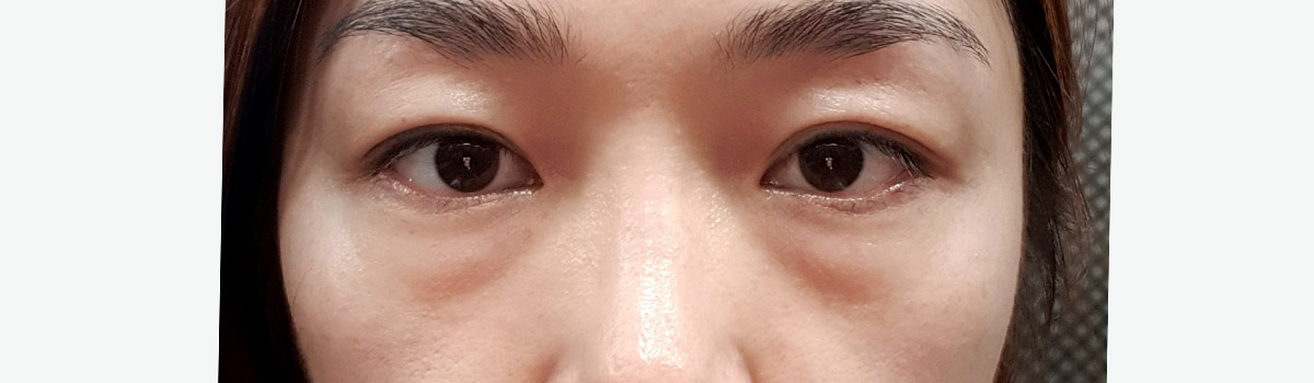눈밑지방 재배치 전후사진