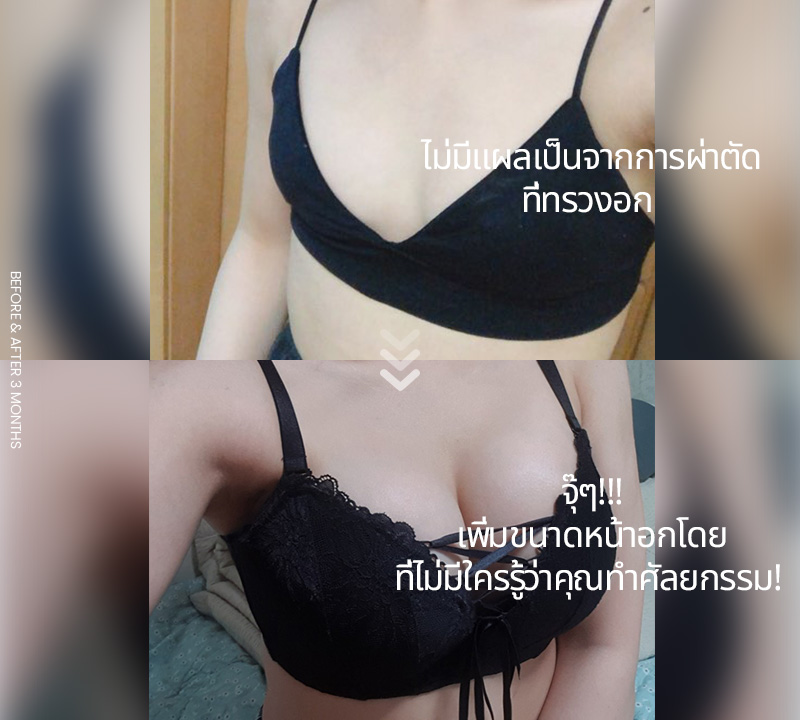 ไม่มีแผลเป็นจากการผ่าตัด ที่ทรวงอก