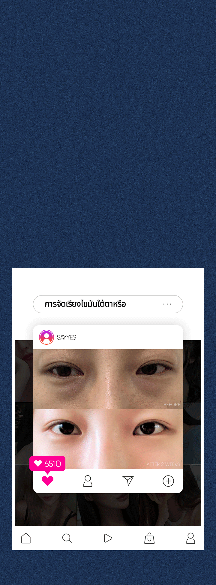 คุณดูเหนื่อยล้าและแก่ขึ้น  เพราะรอยคล้ำใต้ตาและถุงใต้ตาหรือเปล่า  การจัดเรียงไขมันใต้ตา ซึ่งใช้เวลาเพียง 20 นาที! คือคำตอบของคุณ! คุณจะดูอ่อนเยาว์และสดใสมากขึ้น ด้วยเบบี้แฟตใต้ดวงตาและผิวใต้ตาที่เรียบเนียน