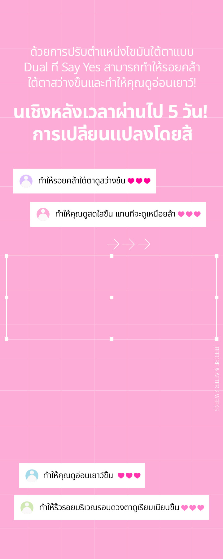 ด้วยการปรับตำแหน่งไขมันใต้ตาแบบ Dual ที่ Say Yes สามารถทำให้รอยคล้ำใต้ตาสว่างขึ้นและทำให้คุณดูอ่อนเยาว์! 