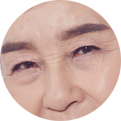 1 หนังตาหย่อนคล้อยมากเกินไป  เนื่องจากอายุที่มากขึ้น 
