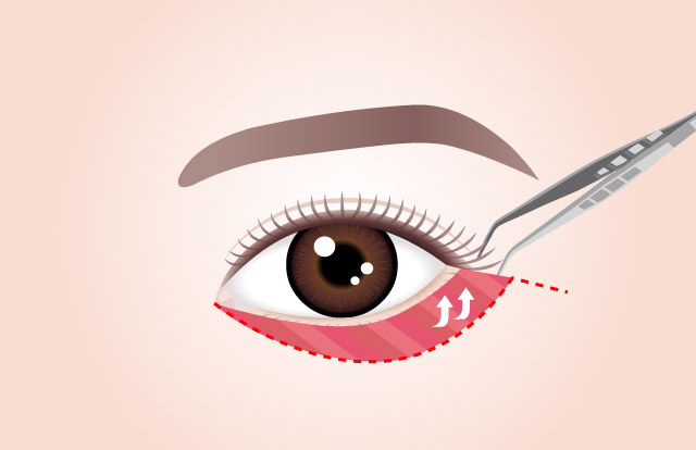 STEP 02 ดึงผิวหนังและกล้ามเนื้อที่หย่อนคล้อยและยึดให้อยู่กับที่