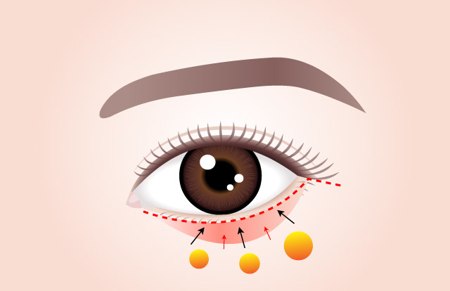 POINT 02 ถูกยึดไว้กับมุมด้านข้างของตา เพื่อป้องกันการกลับมาเป็นใหม่