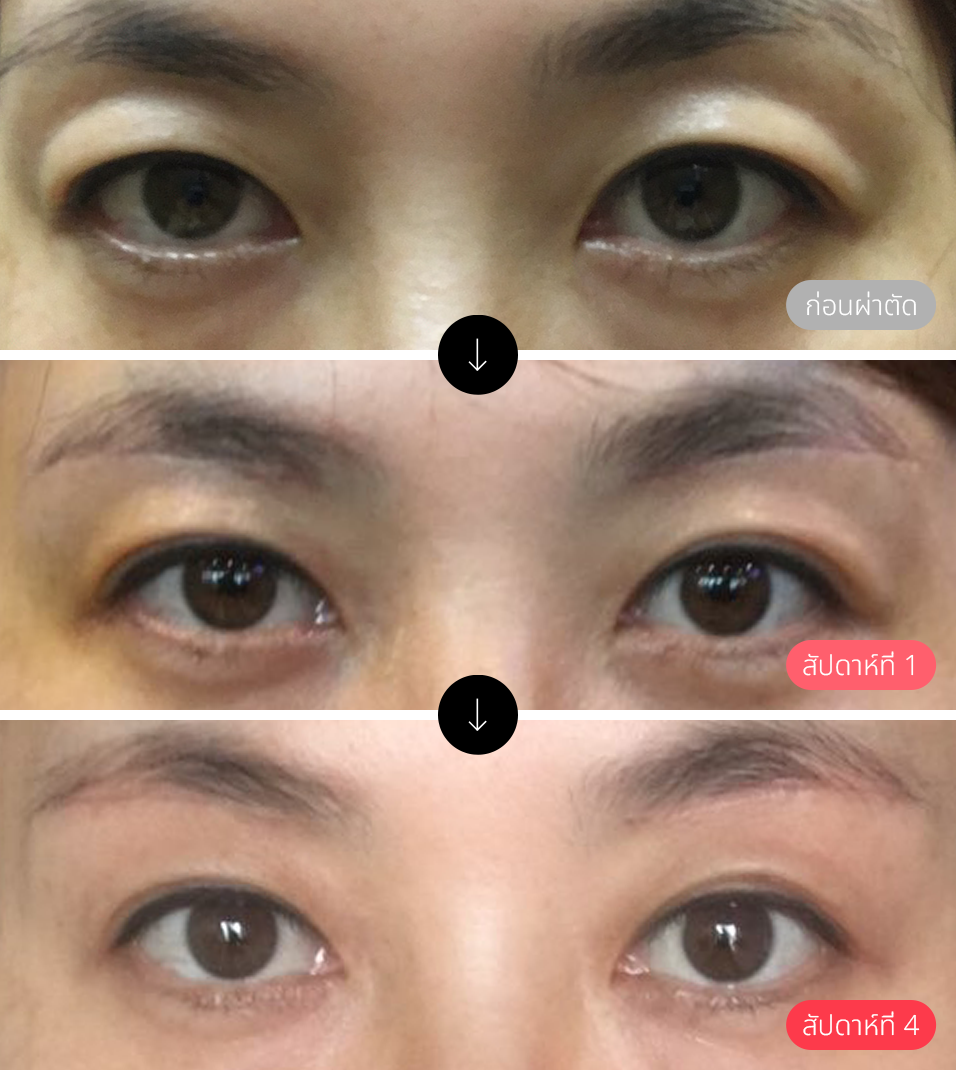 นี่คือภาพที่ถ่ายขึ้นทันทีหลังจากตัดไหมหลังผ่าตัดยกคิ้วให้ผู้รับบริการ คุณสามารถเห็นได้ว่าหลังจากผ่านไปช่วงระยะหนึ่ง รอยแผลจากการผ่าตัดจะจางลงจนแทบมองไม่เห็นจากกระบวนการฟื้นตัว