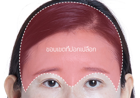 STEP 01 การออกแบบ เราออกแบบแผนการผ่าตัดและออกแบบเปลือกตาบน ตามสภาพอายุของแต่ละบุคคล ทิศทางของริ้วรอย และระดับการหย่อนคล้อยของผิว 