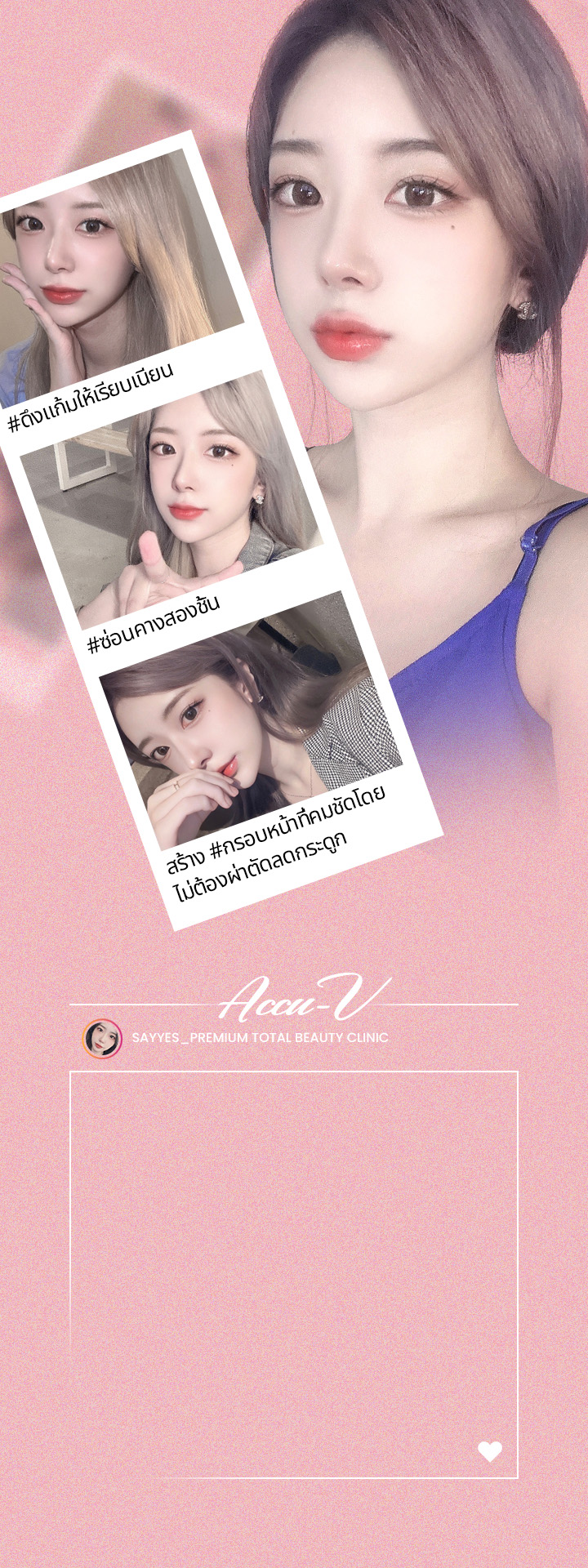 #ดึงแก้มให้เรียบเนียน #ซ่อนคางสองชั้น สร้าง #กรอบหน้าที่คมชัดโดยไม่ต้องผ่าตัดลดกระดูก Accu V การลดขนาดใบหน้า และกำจัดไขมัน