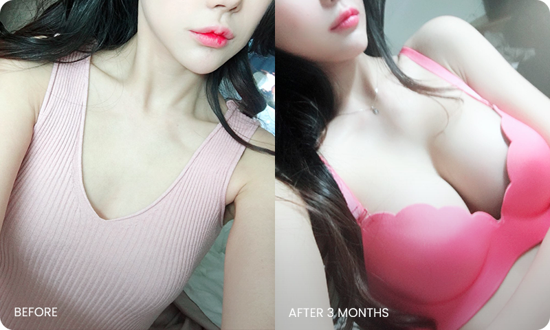 팻브라 전후사진