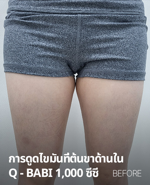 전후사진