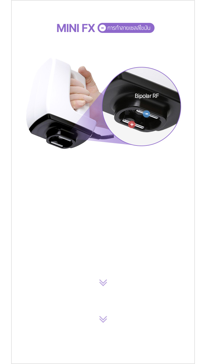 บริเวณที่รักษา를 진공하여 RF열에너지를 균일하게 전달 지방세포에 전기에너지를 전달해 세포막 상처 발생 손상된 지방세포 2~4주 뒤 배출되며 지방감소 효과