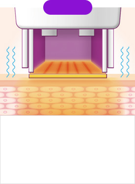 STEP 03 พลังงานความร้อนจากคลื่นวิทยุ ทะลุเข้าสู่ชั้นผิวหนังลึก ลดความเจ็บปวดด้วยการสั่นสะเทือนอย่างต่อเนื่อง