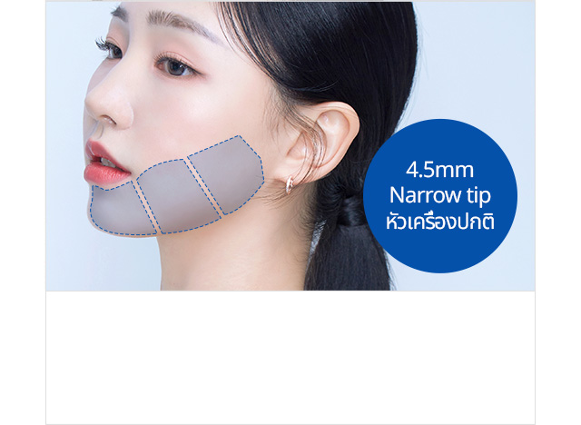 4.5mm Narrow tip หัวเครื่องปกติ สำหรับการยกกระชับชั้นกล้ามเนื้อบริเวณ: กรอบหน้าและโครงหน้าที่หย่อนคล้อย