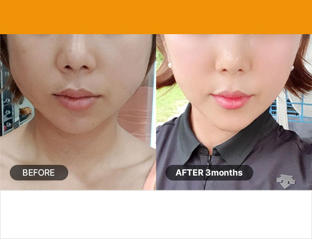 จำนวนช็อต : 300ช็อต / กลุ่มอายุ : 20~30 ต้นๆ ปรับปรุงร่องแก้ม แนวกรามหย่อนคล้อยให้ดีขึ้น ลดขนาดรูขุมขน และป้องกันแก้มตอบ ปลายหัวเครื่องมือ 1.5 มม. (100 ช็อต) + 4.5mm 200ช็อต