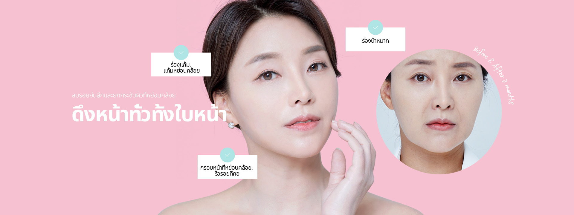 ลบรอยย่นลึกและยกกระชับผิวที่หย่อนคล้อย ดึงหน้าทั่วทั้งใบหน้า