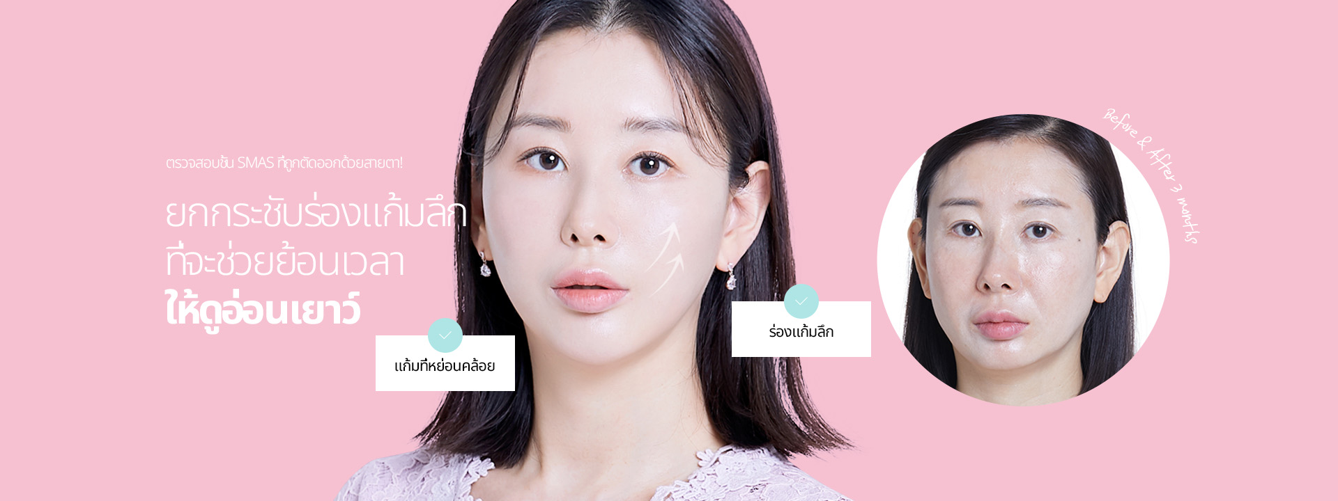 ตรวจสอบชั้น SMAS ที่ถูกตัดออกด้วยสายตา! ยกกระชับร่องแก้มลึก ที่จะช่วยย้อนเวลา ให้ดูอ่อนเยาว์