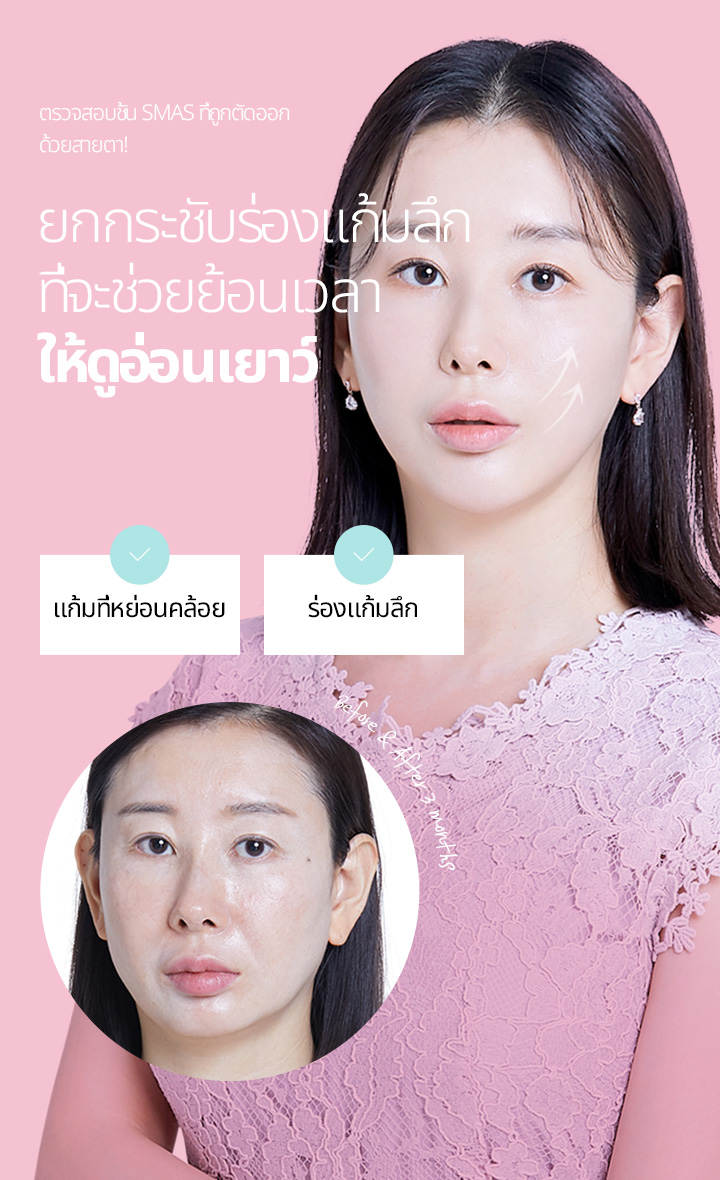 ตรวจสอบชั้น SMAS ที่ถูกตัดออกด้วยสายตา! ยกกระชับร่องแก้มลึก ที่จะช่วยย้อนเวลา ให้ดูอ่อนเยาว์