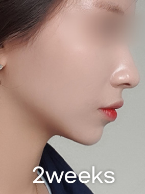 울쎄라 리프팅 전후사진