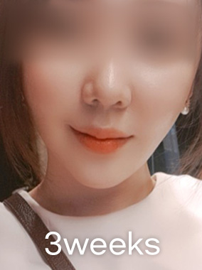 울쎄라 리프팅 전후사진
