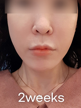 울쎄라 리프팅 전후사진