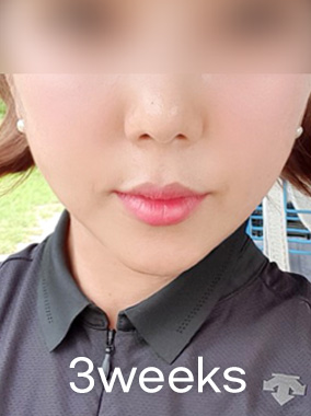 울쎄라 리프팅 전후사진