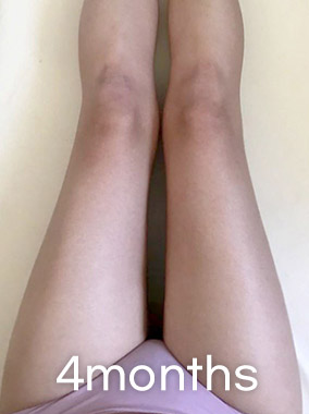 순수지방추출 룩팻 전후사진