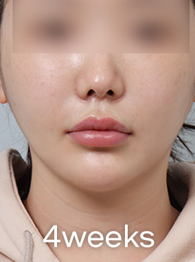 4X มินิ ลิฟติ้ง  전후사진