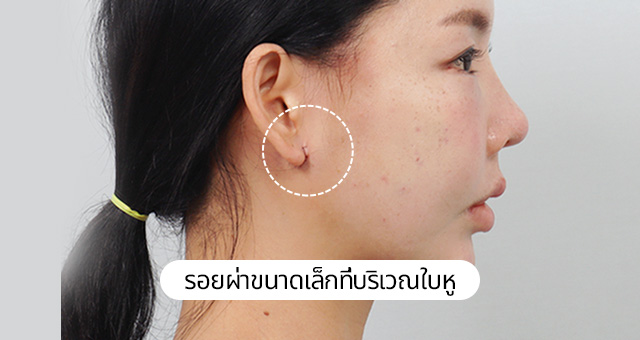 4X มินิ ลิฟติ้งสำหรับกรอบหน้า