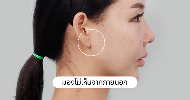 4X มินิ ลิฟติ้งสำหรับกรอบหน้า