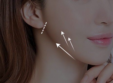 STEP 03 ส่วนของ SMAS จะถูกดึงและยึดให้อยู่กับที่ และตัดผิวหนังส่วนเกินออก 