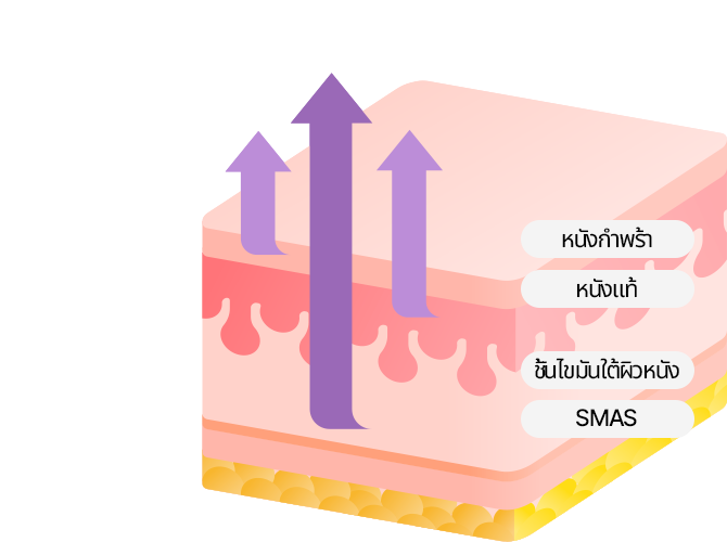 การทำ 4X มินิ ลิฟติ้ง ของ Say Yes  จะดึงผิวชั้นนอก ชั้นหนังแท้ ชั้น SMAS และเอ็นยึดไว้ และดึงผิวที่หย่อนคล้อยจากภายในเพื่อเพิ่มประสิทธิภาพการยกกระชับสูงสุด!
