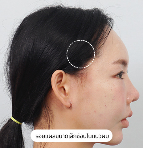 ภาพถ่ายการทำมินิลิฟติ้งที่หน้าผาก