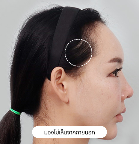 ภาพถ่ายการทำมินิลิฟติ้งที่หน้าผาก