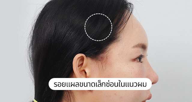 ภาพถ่ายการทำมินิลิฟติ้งที่หน้าผาก