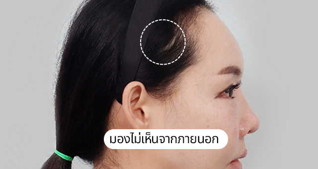 ภาพถ่ายการทำมินิลิฟติ้งที่หน้าผาก