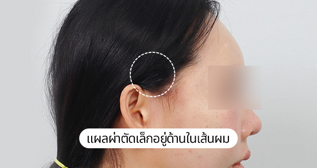 ภาพถ่ายแสดงการยกกระชับร่องแก้มแบบมินิ